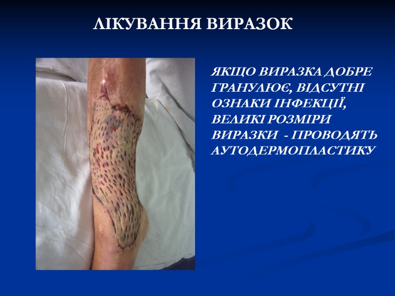 ЛІКУВАННЯ ВИРАЗОК ЯКЩО ВИРАЗКА ДОБРЕ ГРАНУЛЮЄ, ВІДСУТНІ ОЗНАКИ ІНФЕКЦІЇ, ВЕЛИКІ РОЗМІРИ ВИРАЗКИ - ЛІКУВАННЯ ВИРАЗОК ЯКЩО ВИРАЗКА ДОБРЕ ГРАНУЛЮЄ, ВІДСУТНІ ОЗНАКИ ІНФЕКЦІЇ, ВЕЛИКІ РОЗМІРИ ВИРАЗКИ -